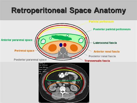 Figure 20 From Retroperitoneal Spaces Anatomy And Perirenal Collections