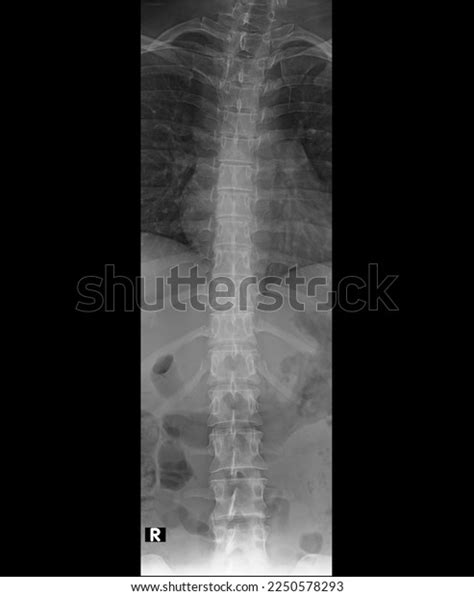 Normal Thoracic Spine Xray Ap Lateral Stock Photo 2250578293 Shutterstock