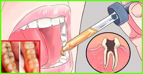 We did not find results for: Decaying Tooth Home Remes - Homemade Ftempo