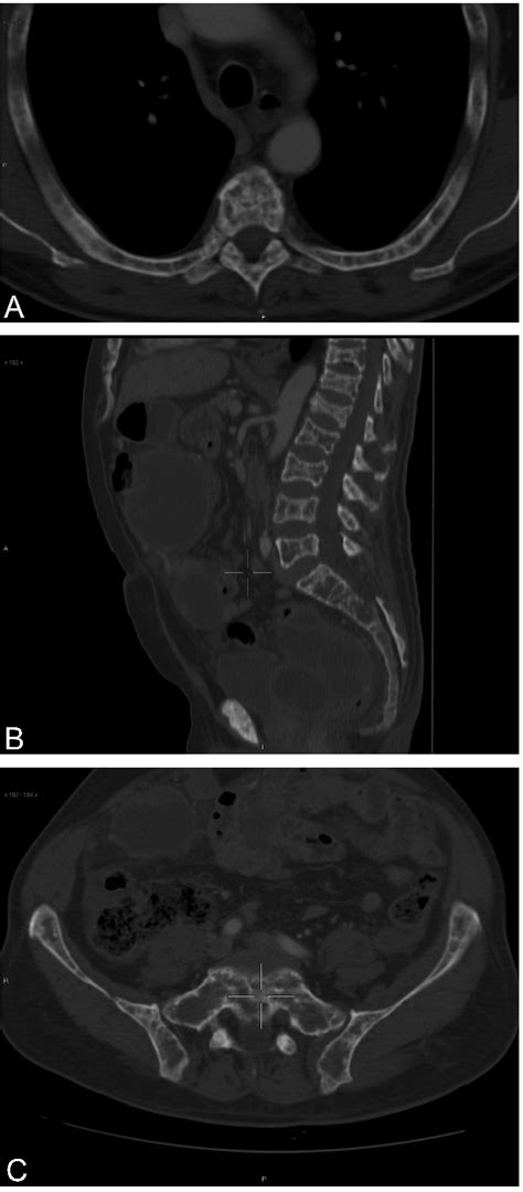 A Multiple Lytic Lesions Of The Ribs And Vertebral Body B Multiple