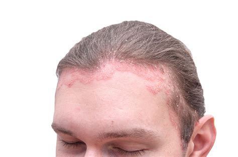 Red Spots On Scalp Pictures Causes And Treatments Vlrengbr