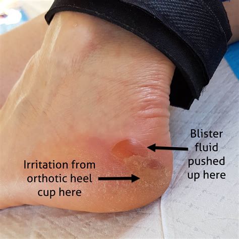 Orthotics Causing Posterior Heel Edge Blisters Lesson 5 From Adelaide