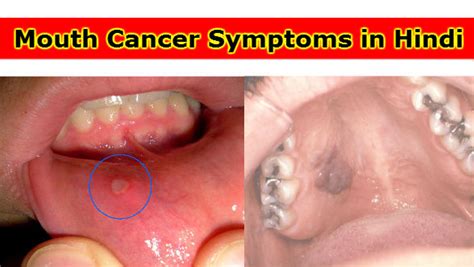 What Do The Early Stages Of Mouth Cancer Look Like In Hindi What Are