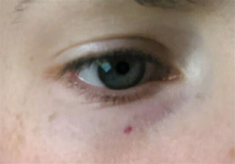 Weird Spot Under My Eye Picappeared Overnight Babycenter