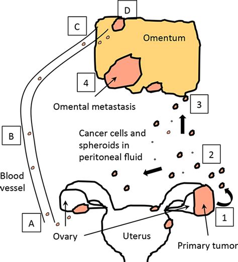 Ovarian Cancer Metastasis A Unique Mechanism Of Dissemination Intechopen