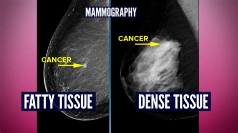 Do You Have Dense Breasts You May Need More Than A Mammogram TODAY