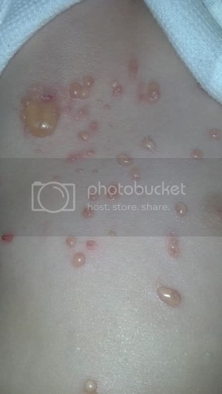 Molluscum Contagiosum Infection Treatment Before And After