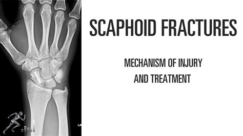 Scaphoid Fracture Mechanism Of Injury And Treatment Options Of This