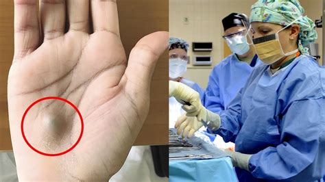 A Man Found This Strange Lump On His Palm Then A Scan Revealed