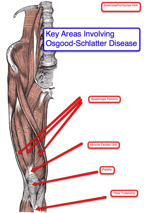 Osgood Schlatters Disease Exercises For Injuries