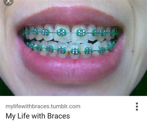 Green Braces Braces Colors Green Braces Dental Braces Colors
