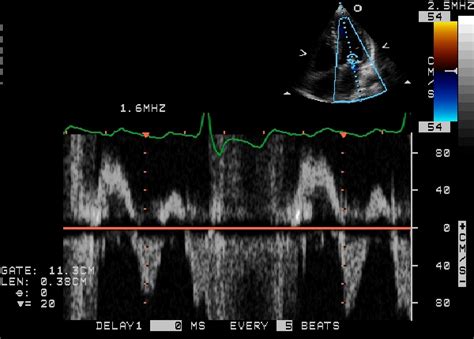 Mitral Regurgitation Echocardiography Wikidoc