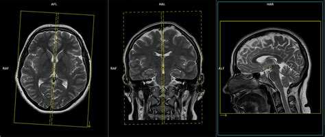 Mri Brain Protocols Planning Positioning And Indications