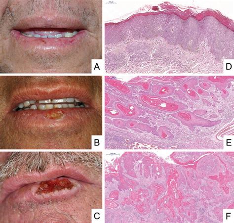Basal Cell Carcinoma On Lip