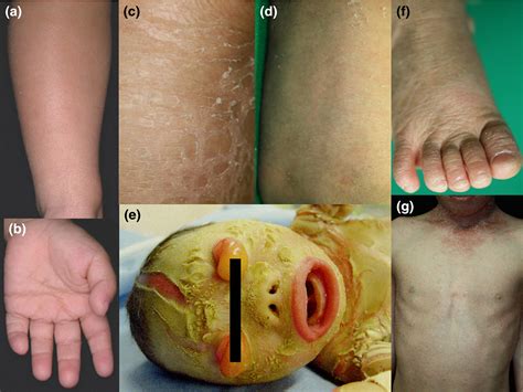 Inherited Ichthyosis Non‐syndromic Forms Takeichi 2016 The