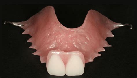 Single Tooth Denture Atlas Dental Toronto