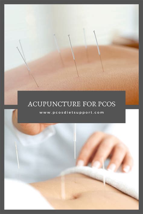Acupuncture For Pcos Pcos Acupuncture Acupuncture Fertility