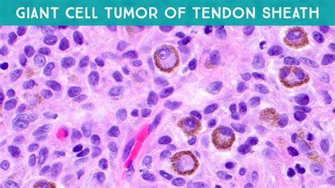 Giant Cell Tumor Of Tendon Sheath Tenosynovial Giant Cell Tumor