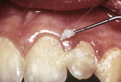 Dental Plaque And Gum Disease Stock Image C Science Photo