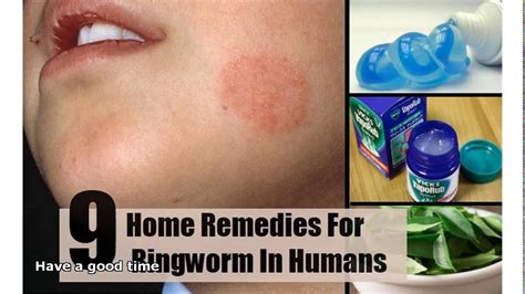 15 Natural Home Remedies For Ringworm Ringworm Is A Universal Skin