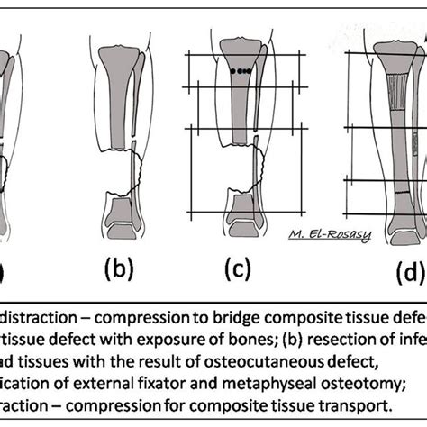 Pdf Definition Of Bone Transport From An Orthoplastic Perspective