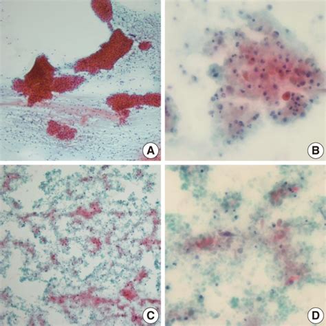 Cytologic Findings Of The Warthins Tumor Cases Showing Diagnostic