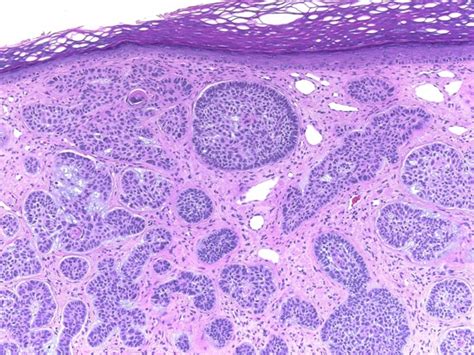 Basal Cell Carcinoma Of The Skin Usmle Strike
