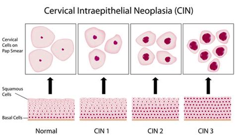 Hpv Pap Smear Test Results Amashusho Images