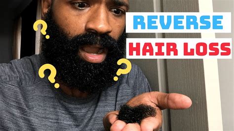 How I Reversed And Stopped My Hair Loss Black Men S Hair Loss Youtube