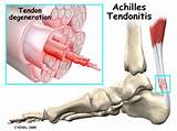Tendonitis Therapy Images