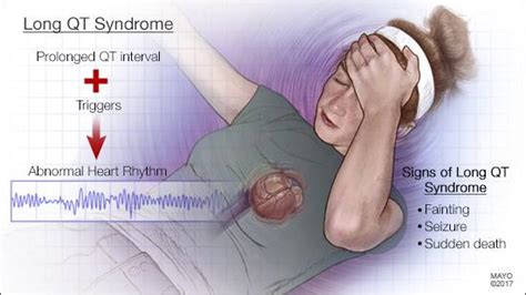 Mayo Clinic Q And A Understanding And Treating Long Qt Syndrome Mayo