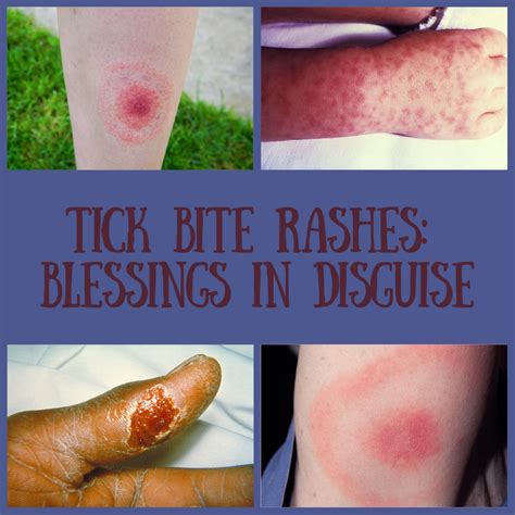Tick Bite Rashes Blessings In Disguise Tick Bite Tick Bite Rash