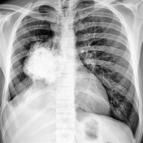 Chest Radiograph Showing A Large Mass Lesion Arising From The Right