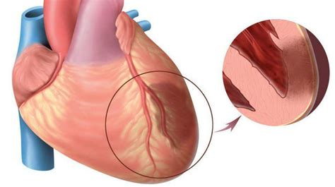 Myocardial Infarction The First Signs Of A Heart Attack Methods Of