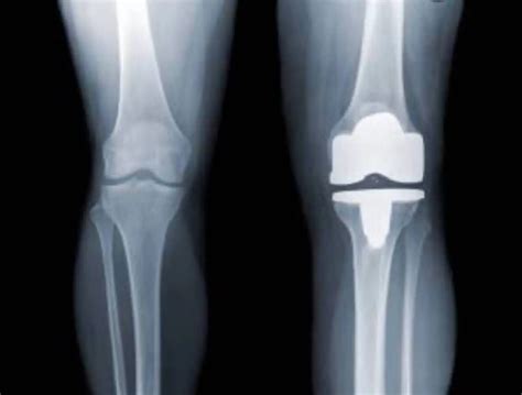 Total Knee Replacements Tips To Avoiding Surgery For Knee Pain