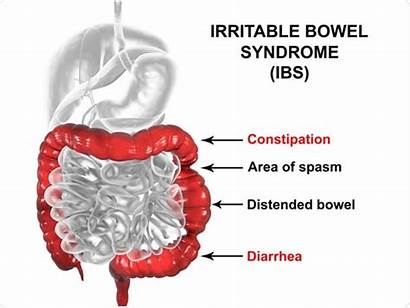 Ibs Bowel Irritable Syndrome Sibo 3d Intestine