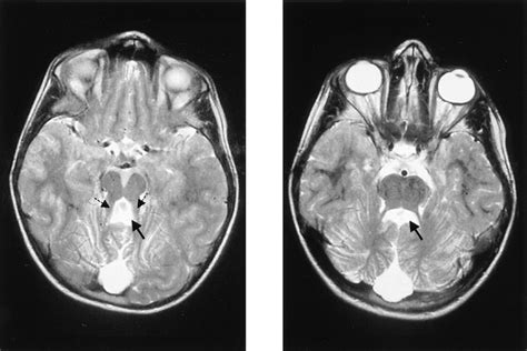 Mri Findings In Cerebellar Vermis Agenesis Left Axial T 2 Weighted