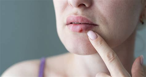 What Causes Cold Sores And What Are Some Ways To Treat Them