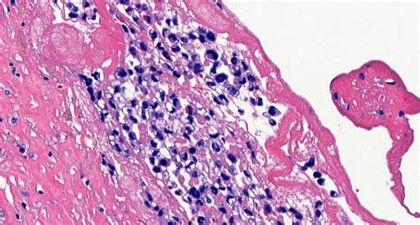 Pathology Outlines Breast Implant Associated Anaplastic Large Cell