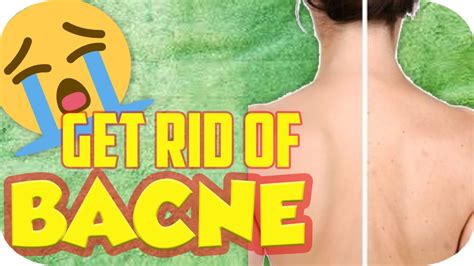 How To Get Rid Of Back Acne Bacne Treatment Youtube