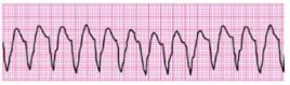 Considere os traçados eletrocardiográficos ECG apresentado