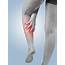 Sprained Calf Muscle Injury In Norwich Full Recovery With 
