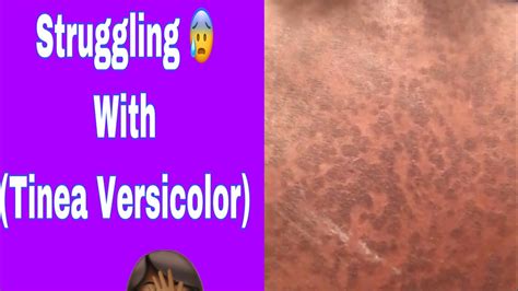 Still Suffering With Tinea Versicolor Youtube