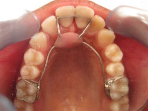 Modified Nance Palatal Arch Appliance For Anterior Tooth Replacement
