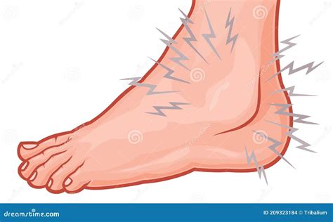 Human Ankle Sprain Vector Illustration Stock Vector Illustration Of