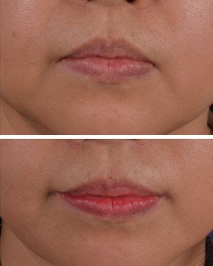 Mouth Corner Which Is Drooping Seriously Dermal Fillers Lip Lift