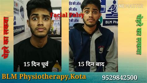 Facial Palsy Bells Palsy Treat By Physiotherapy With In Days Youtube