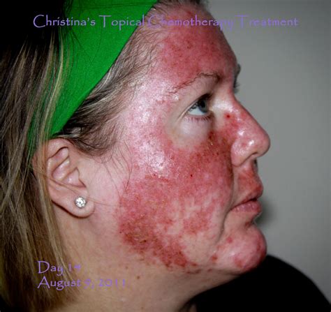 My Journey Through Topical Chemotherapy Fluorouracil 5 Cream And