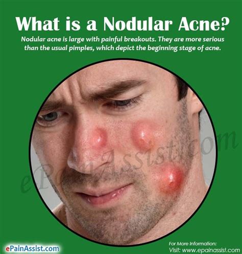 How To Treat Cystic Nodular Acne