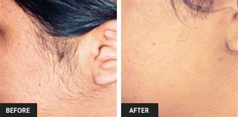 Brazilian Laser Hair Removal Before And After Brazilian Laser Hair